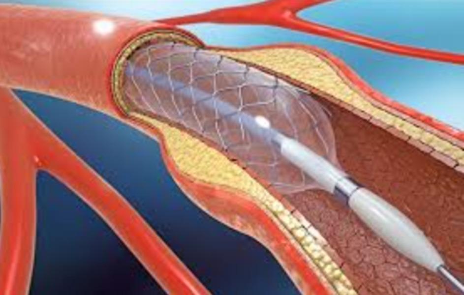 Facilitated angioplasty is oft