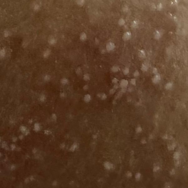 Dr.s.Valarmathi, a skin doctor