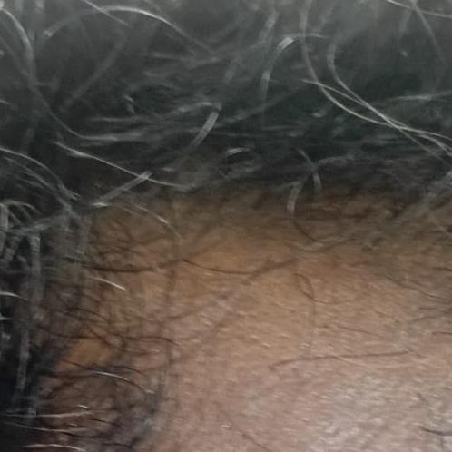 Dr.s.Valarmathi, a dermatologi