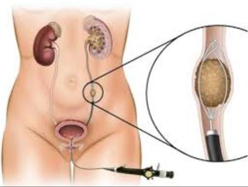 Ureteric stone retrieval becom
