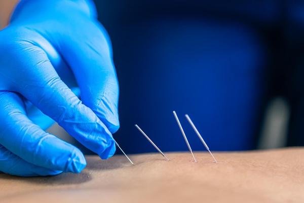 Dry needling is becoming a pre