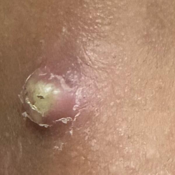 Dr.Valarmathi, a skin doctor i