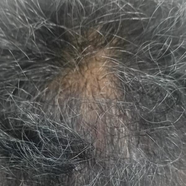 Dr.s.Valarmathi, a dermatologi