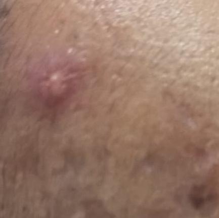 top acne treatment thillai nag