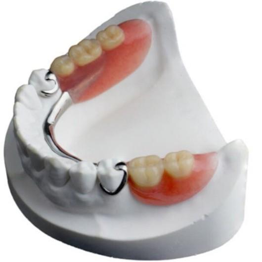 Cast Partial Dentures in Great