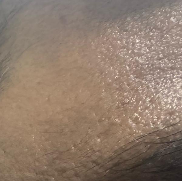 top pigmentation treatment wor