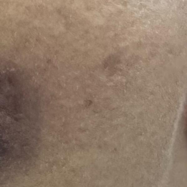 affordable pigmentation treatm