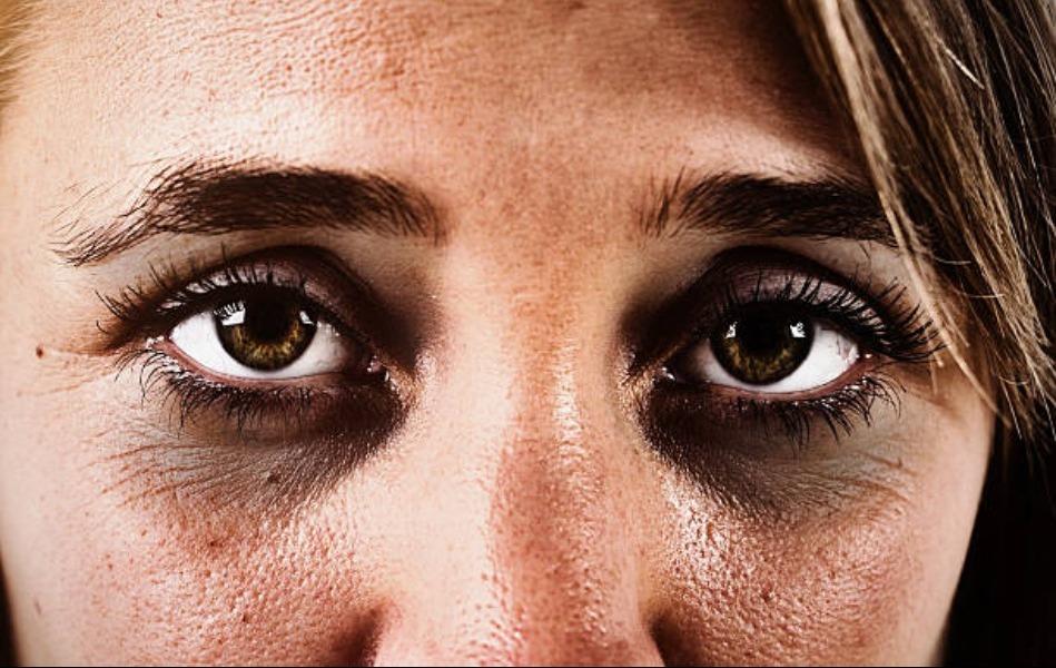 Undereye Dark Circle Treatment