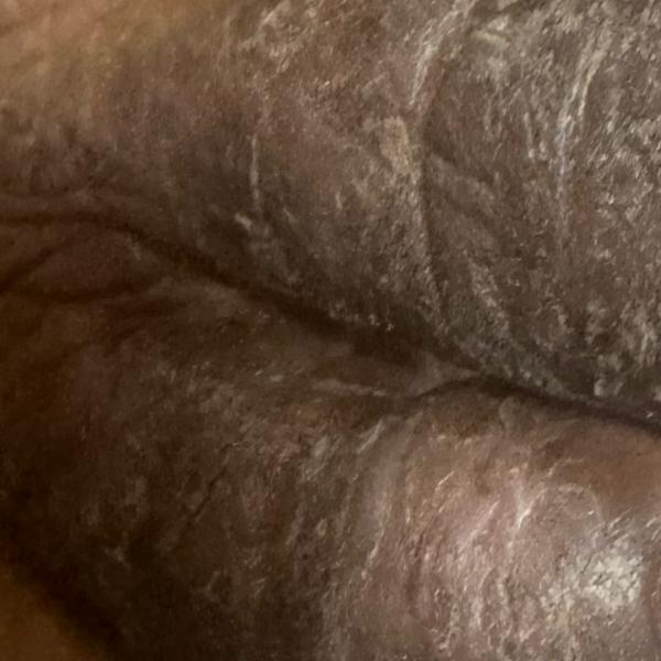 trichy skin allergy treatment