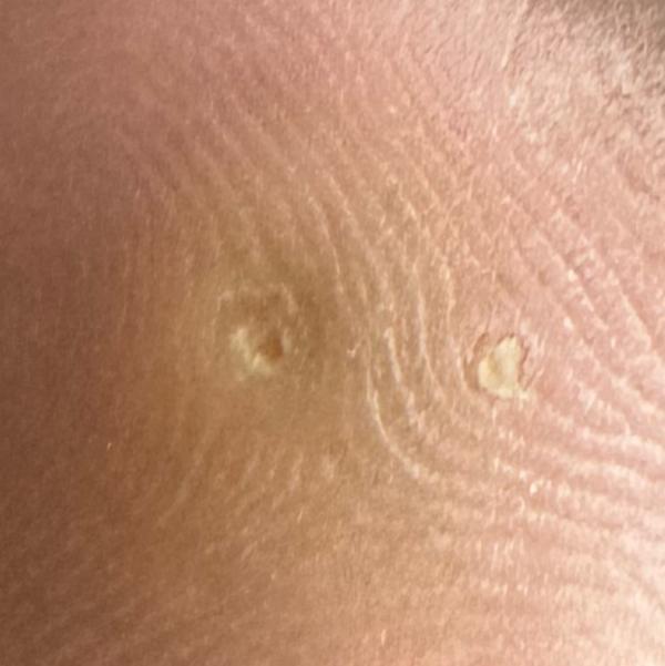 wart removal treatment woraiyu