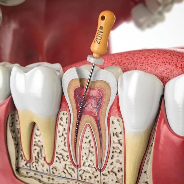 # Root Canal Treatment in Noid