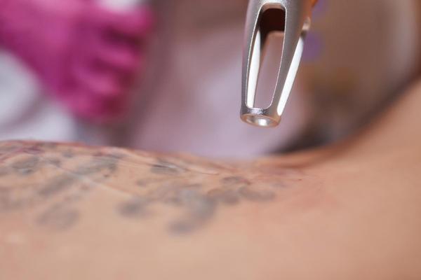 Tattoo removal is often a deep