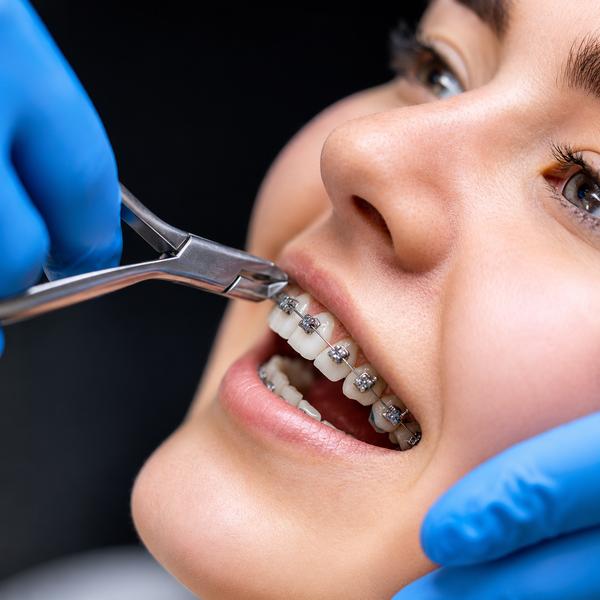 Braces Treatment in Malviya Na