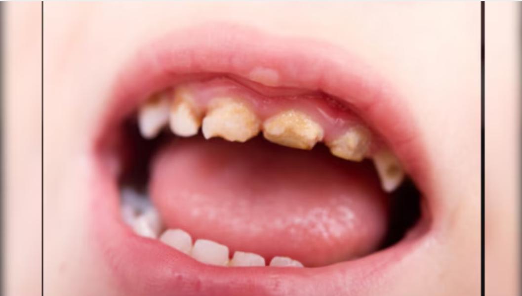 orthodontic braces clear align