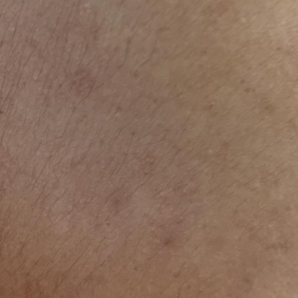 hydrafacial treatment in trich