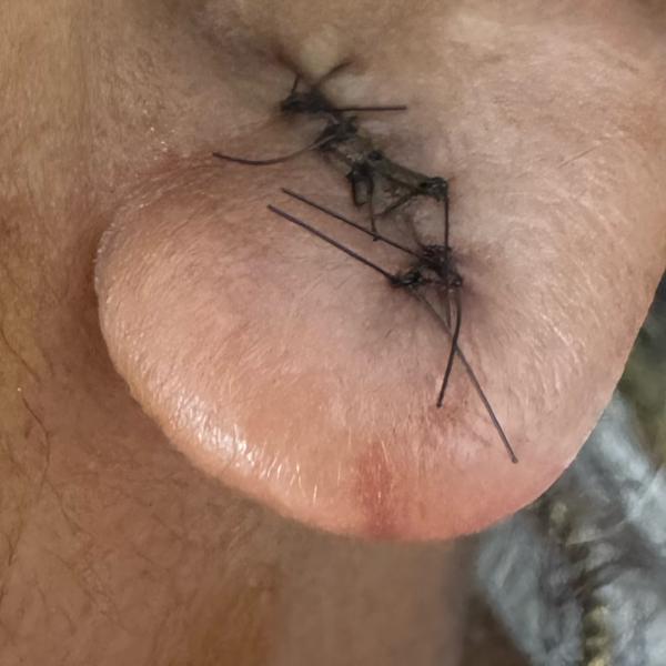 ringworm infection treatment t
