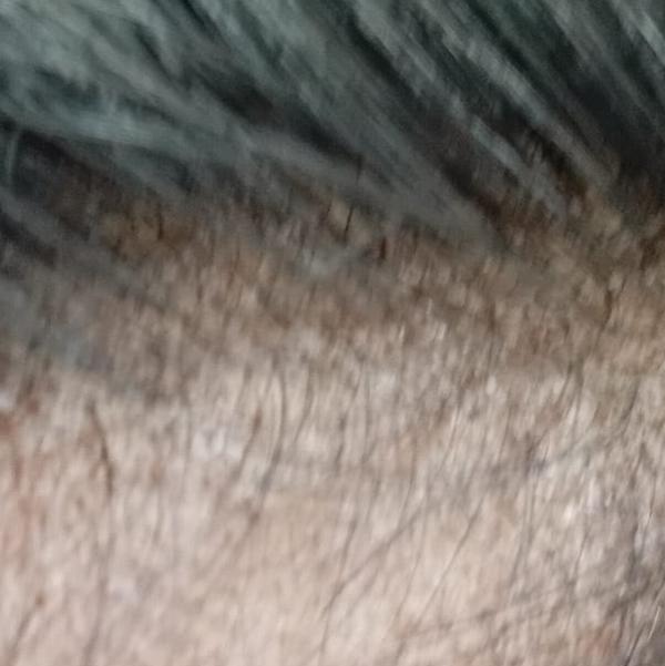 hair loss dandruff treatment t