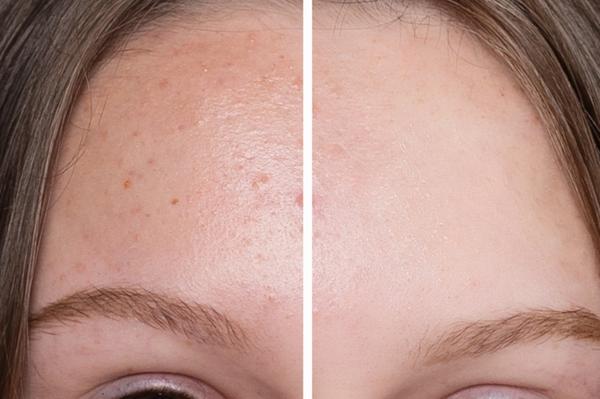 Open pores