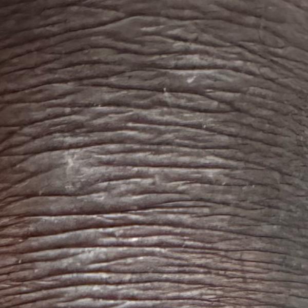 psoriasis treatments trichy
