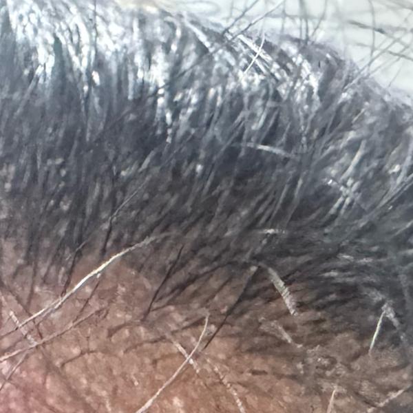 hair loss dandruff treatment t