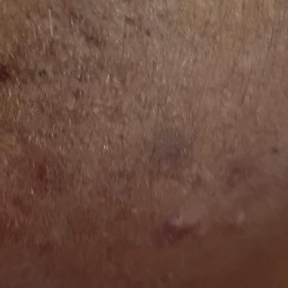 Dr.s.Valarmathi, an acne treat