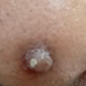 Dr.s.Valarmathi, a wart remova