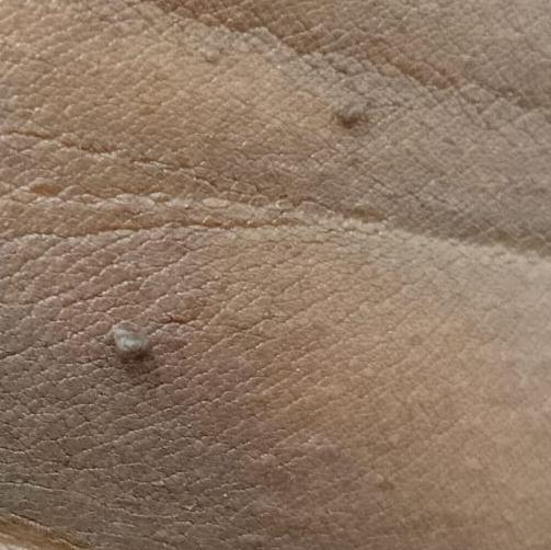 Dr.s.Valarmathi, the best derm