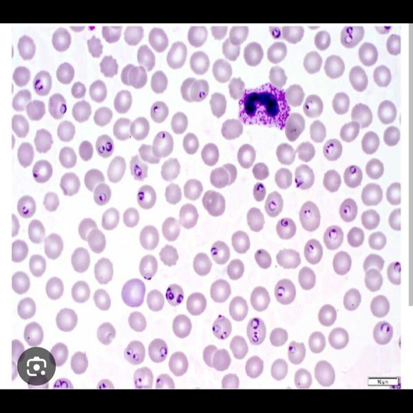 A Peripheral Smear (PS) for Ma