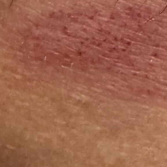Dr.s.Valarmathi, a psoriasis d