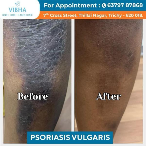 eczema treatment specialist in