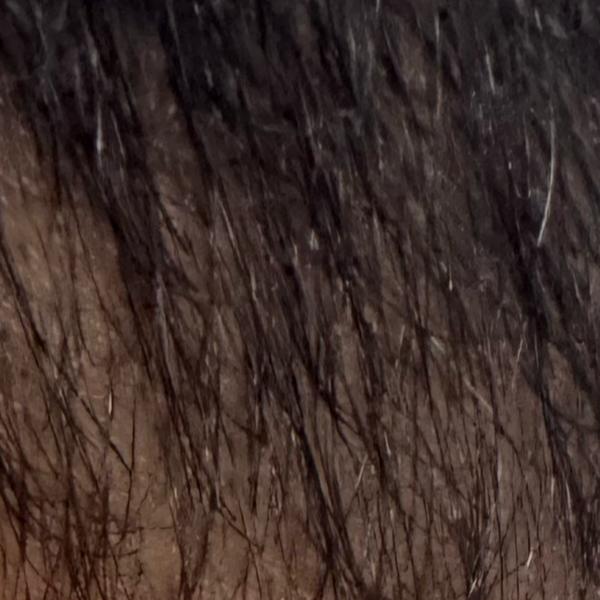 hair loss dandruff treatment t