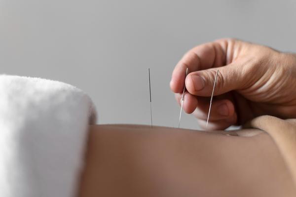 Needling therapy has become a 