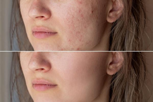 Acne scars