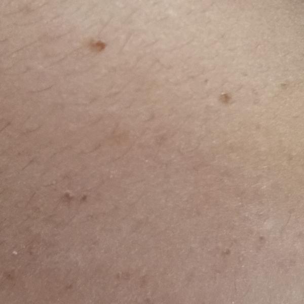 wart removal near me