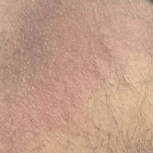 eczema treatment specialist in