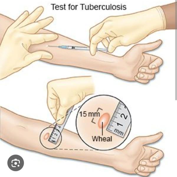 Tuberculin