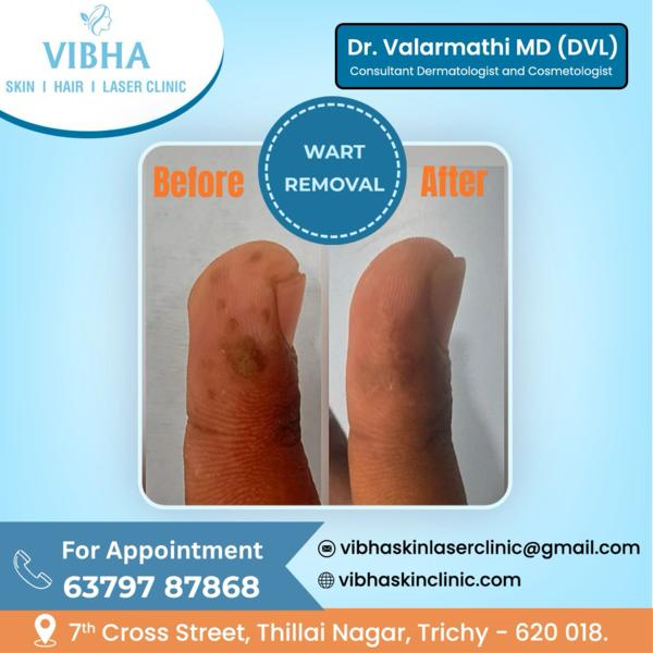wart removal near me