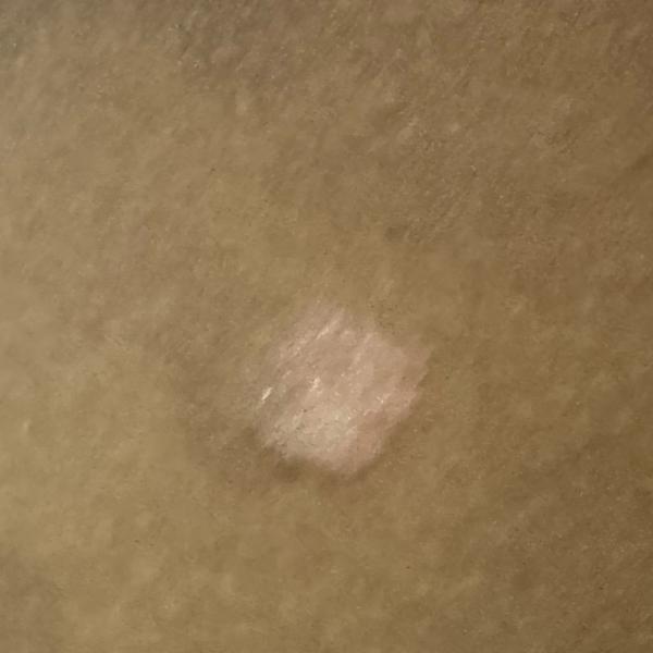 trichy skin allergy treatment