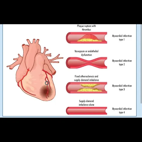 A troponin blood test measures