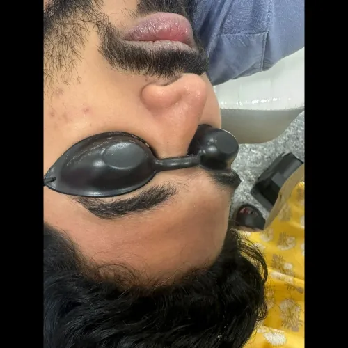 Pigmentation treatment in Derm