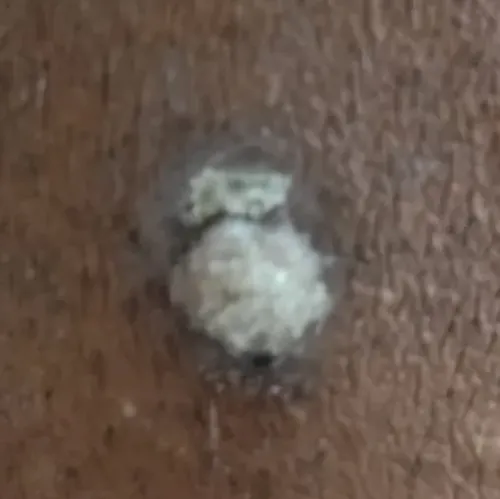 Dr.s.Valarmathi, a wart remova