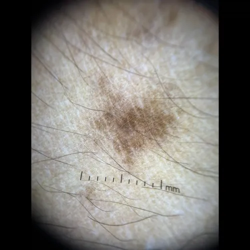 dermatology hair loss solution