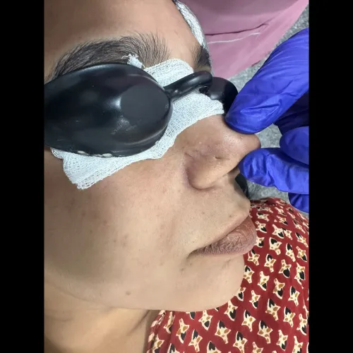 Laser hair removal is a non-in