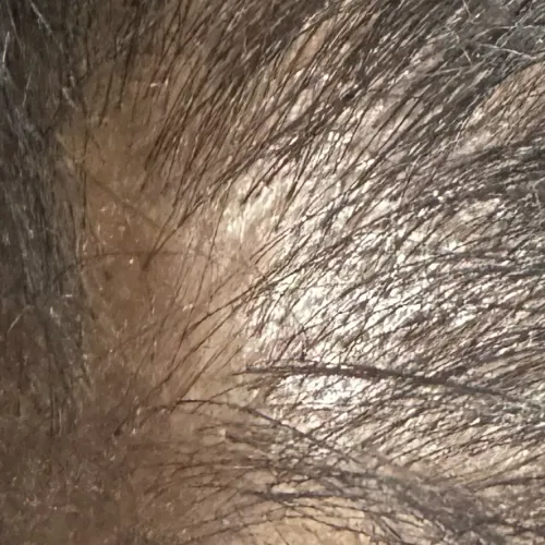 scalp biopsy in trichy