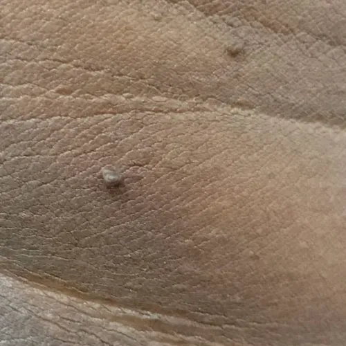 Dr.s.Valarmathi, a skin tag re