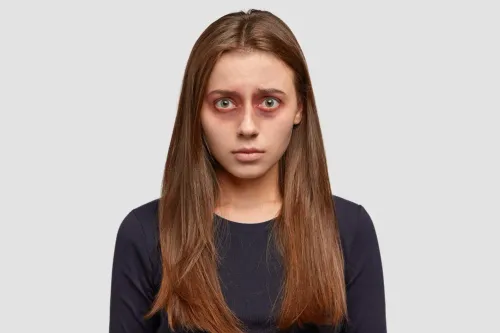 Dark circles are among the mos