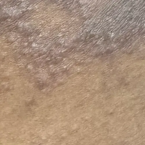 Dr.s.Valarmathi, a skin doctor