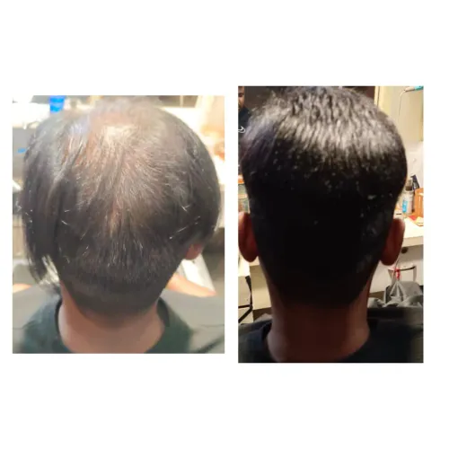 Sometimes, people want a hair replacemen