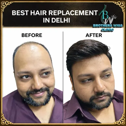 Hair loss affects millions of 