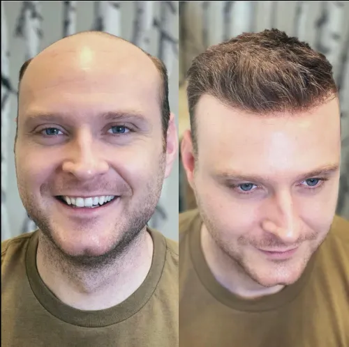 customize every hair patch